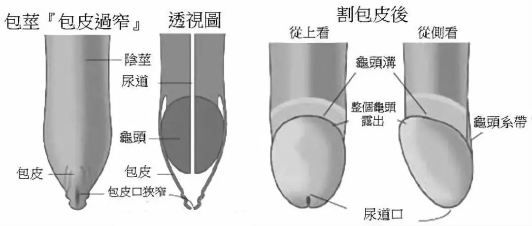 龟头嵌顿会不会自己撑大