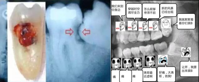 每个人都要拔智齿吗,如何说服自己去拔除智齿？