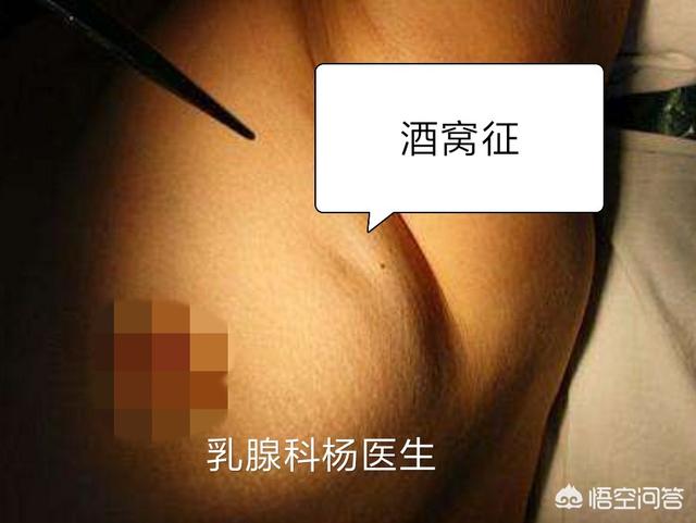 乳腺肿瘤有什么症状,乳腺癌的早期症状有哪些？