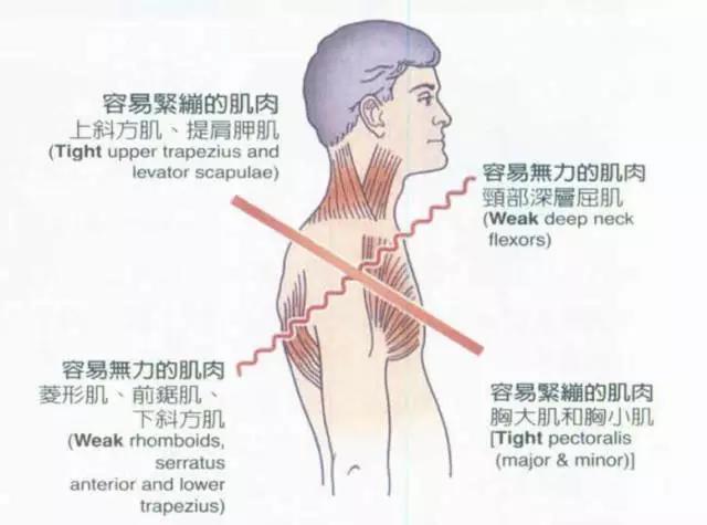 颈椎前倾严重如何矫正,什么锻炼可以改善脖子前倾？