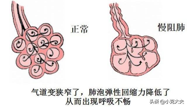 肺功能检查外推容积是什么意思,FVC的中文意思是什么？