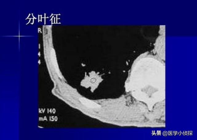 ct容积效应是好是坏,宝宝真的不能拍胸片，做CT吗？