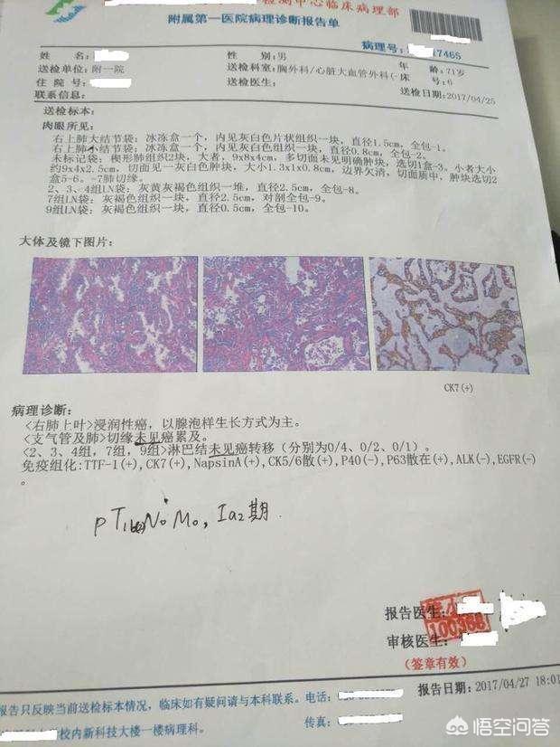 肺功能报告单主要看哪几项,肺部CT平扫检查准确吗？