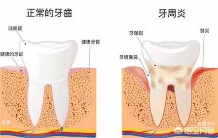 口气重是什么原因引起的,长期口臭会是什么原因导致的？