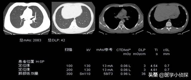 ct容积效应是好是坏,是不是体检最好不要照CT？