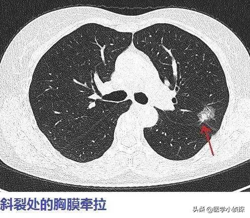 ct容积效应是好是坏,是不是体检最好不要照CT？