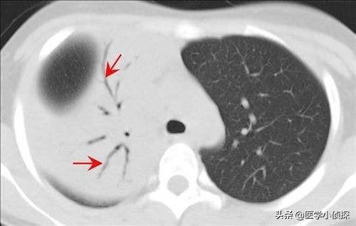 ct容积效应是好是坏,是不是体检最好不要照CT？