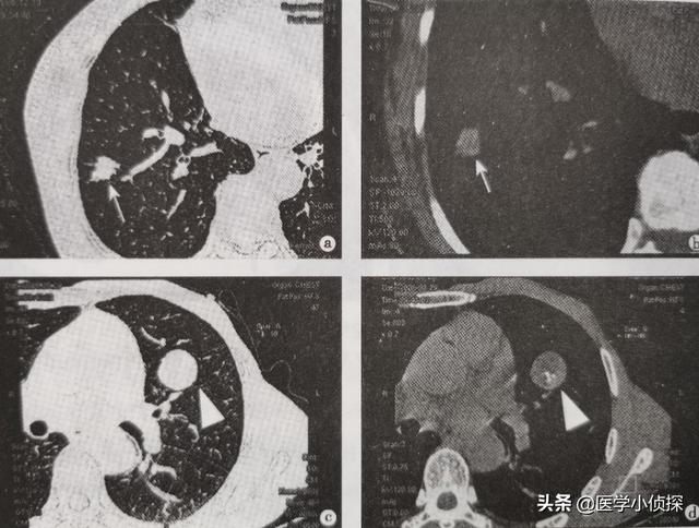 肺功能外推容积小于0,怎么解读肺部小结节大小？