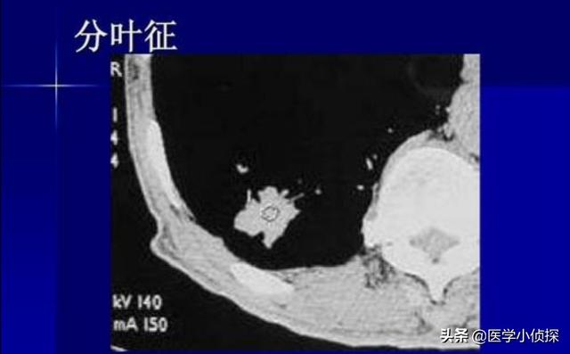 肺功能外推容积小于0,怎么解读肺部小结节大小？