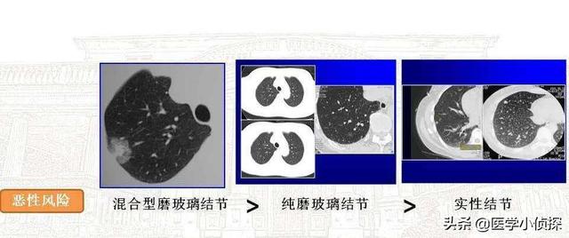 肺功能外推容积小于0,怎么解读肺部小结节大小？