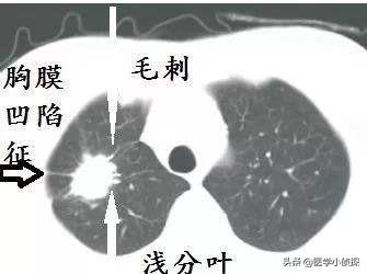 肺功能外推容积小于0,怎么解读肺部小结节大小？