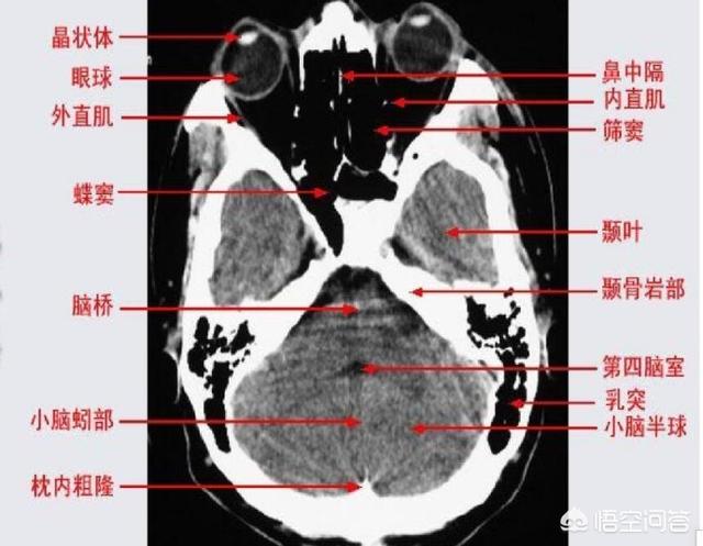 头颅ct容积效应所致是什么意思,宝宝做脑ct有什么影响？