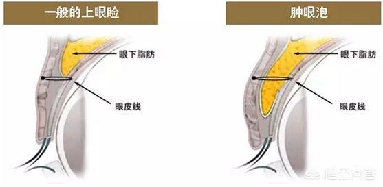 现在做双眼皮，什么样的比较好？,双眼皮做什么样的比较好