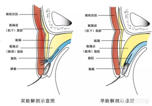 现在做双眼皮，什么样的比较好？,双眼皮做什么样的比较好