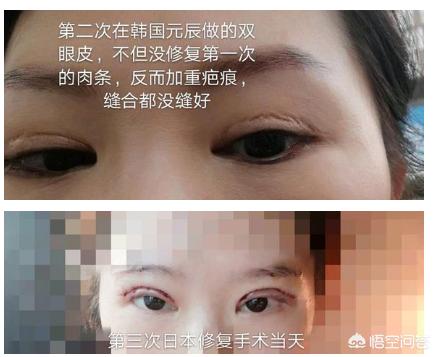 现在做双眼皮，什么样的比较好？,双眼皮做什么样的比较好