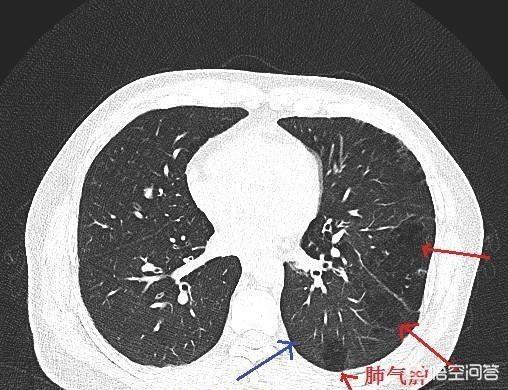 肺功能外推容积计算,遇到气胸，如何计算肺压缩程度？