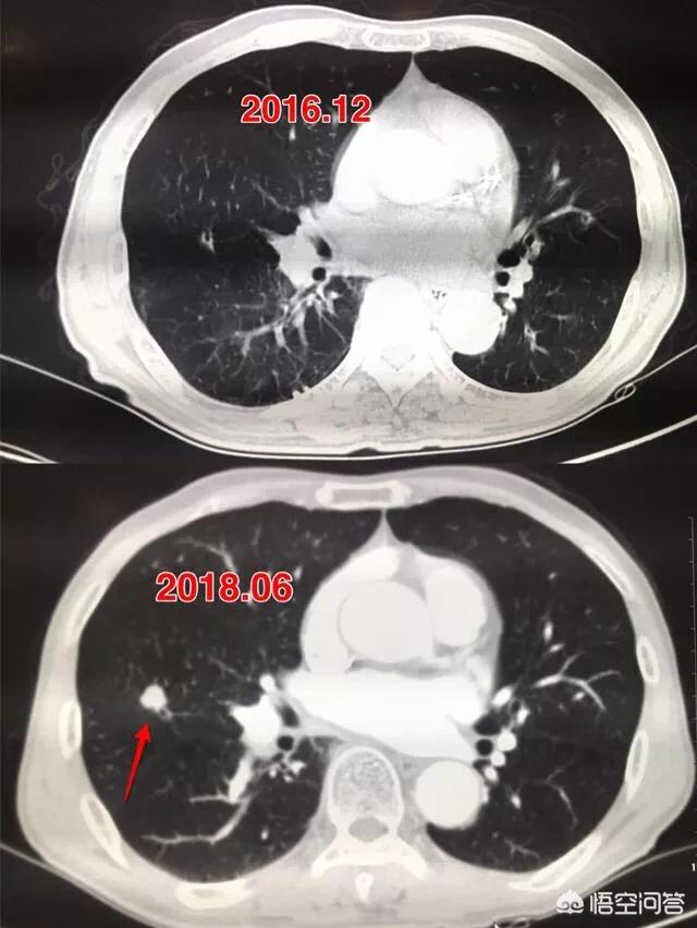 肺功能外推容积小于0,肺部有0.5结节危险吗？