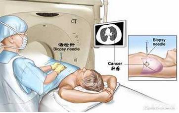 肺功能外推容积计算,肺穿刺活检，有哪些风险？