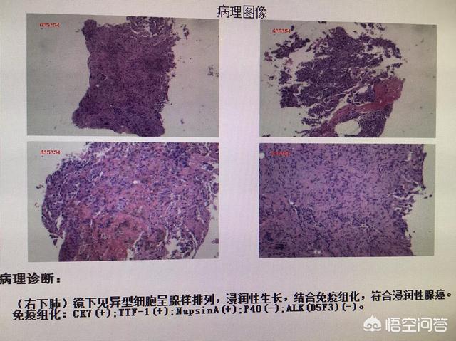 肺癌图片,一张片子就能诊断肺癌吗？