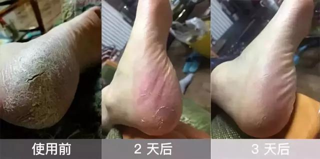 手脱皮修复霜,加拿大修护好物空降！10年干裂脚、手脱皮，3天修复