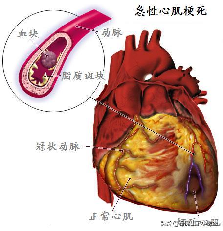 长期吸二手烟的危害,心梗放了支架能闻二手烟吗？