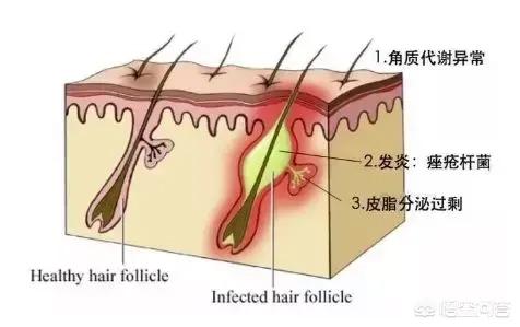 痘痘和痤疮的区别图片,脸上痘痘特别密集是痤疮吗？