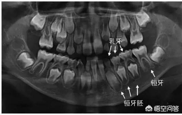 儿童换牙顺序,孩子换牙掉了多久能长出来？