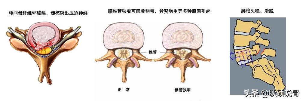 治疗腰间盘突出的办法,腰间盘突出最佳治疗方法有哪些？