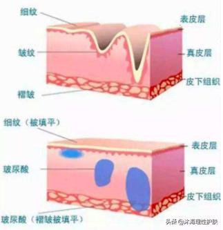 法令纹去除,如何祛除法令纹和抬头纹？