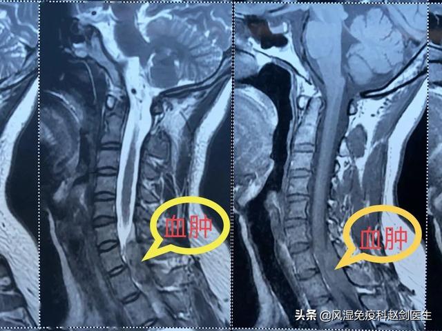 颈椎病如何医治,颈椎病正确的医治方法有哪些？