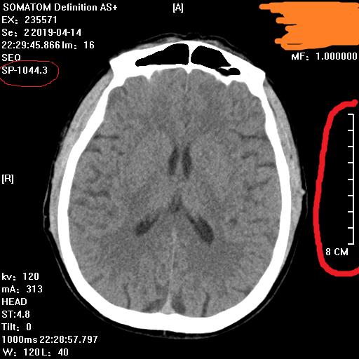 ct片,CT片子的肿瘤怎么知道有多大？