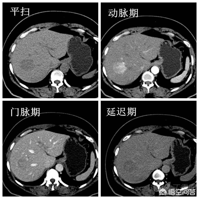 ct片,CT片子的肿瘤怎么知道有多大？