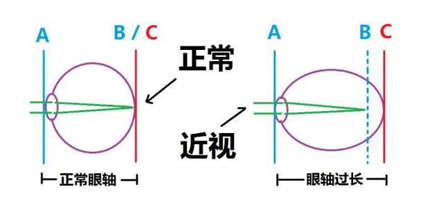 先天性近视能治好吗,儿童得了真性近视还能治好吗？