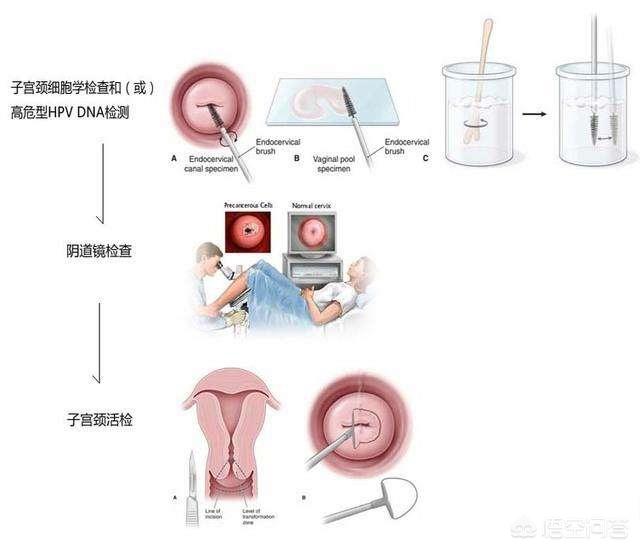 宫颈癌高发年龄,HPV感染的情况常见吗？