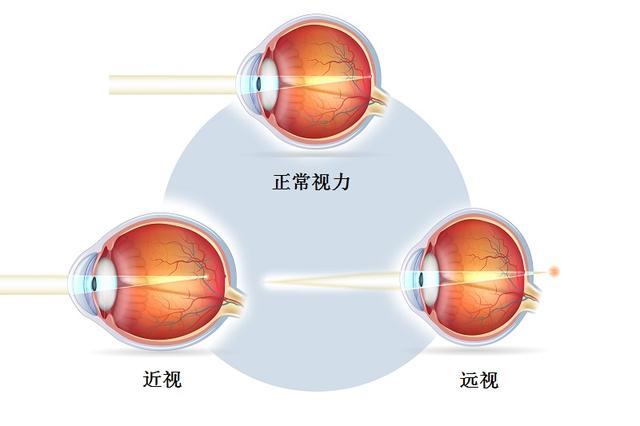 近视不戴眼镜的后果,近视不戴眼镜有哪些危害？