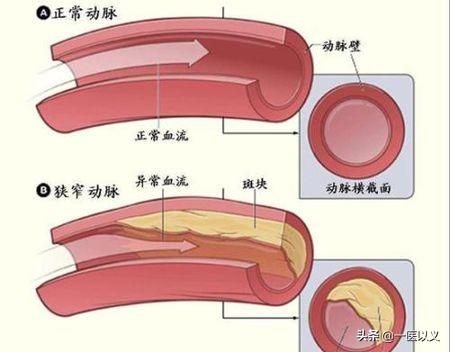 腔梗是什么意思,腔隙性脑梗塞到底是什么？