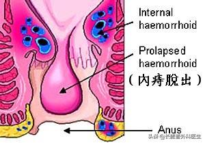 怎么知道自己是不是长了痔疮,长了痔疮要注意什么事情呢？