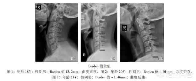 颈椎前倾严重如何矫正,健身可以纠正驼背和头前倾吗？