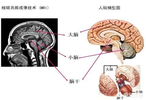 小脑萎缩的症状,小脑萎缩可以导致什么症状发生？