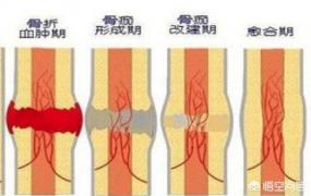 伤筋动骨一百天,骨折真的要伤筋动骨一百天吗？