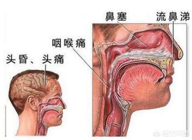 鼻炎的症状表现,什么是鼻窦炎，有哪些表现？