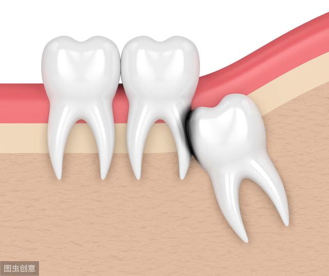 智齿痛,拔智齿疼吗？拔完智齿会疼几天？