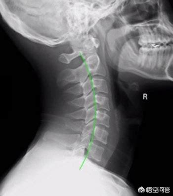 颈椎前倾,颈椎病如何判断前倾、后倾问题？