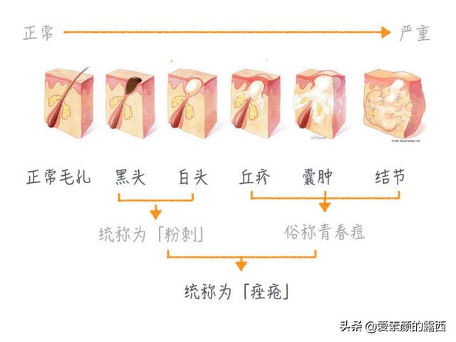 最有效的去黑头产品,去黑头最好的方法有哪些？