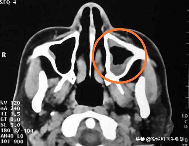 鼻窦炎吃什么药见效快,4岁孩子得了鼻窦炎，怎么办？