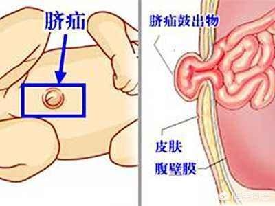 新生儿脐疝,宝宝刚满月，脐疝严重怎么办？