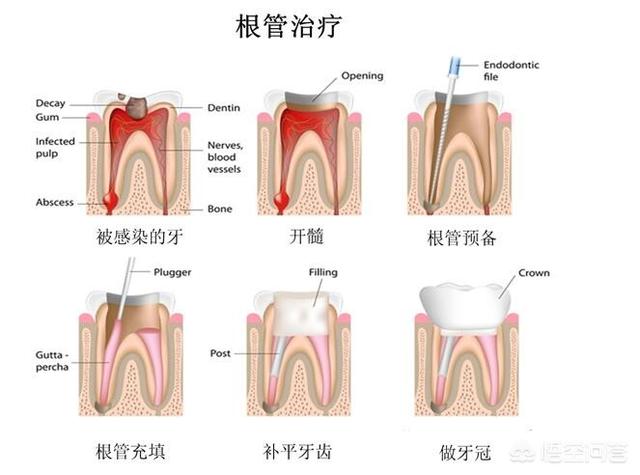 戴牙套有什么副作用,牙齿的根管治疗有什么危害？