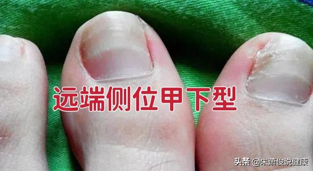 教你怎么治灰指甲,灰指甲用什么方法能治好？