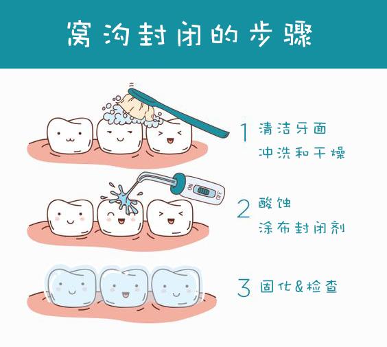 孩子做窝沟封闭的利弊,小宝宝牙齿需要做窝沟封闭吗？