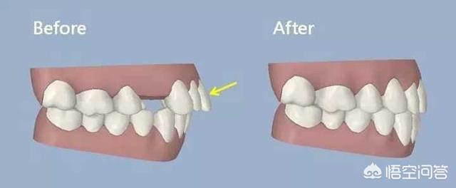 黑三角牙齿,牙齿矫正中如何避免出现黑三角？
